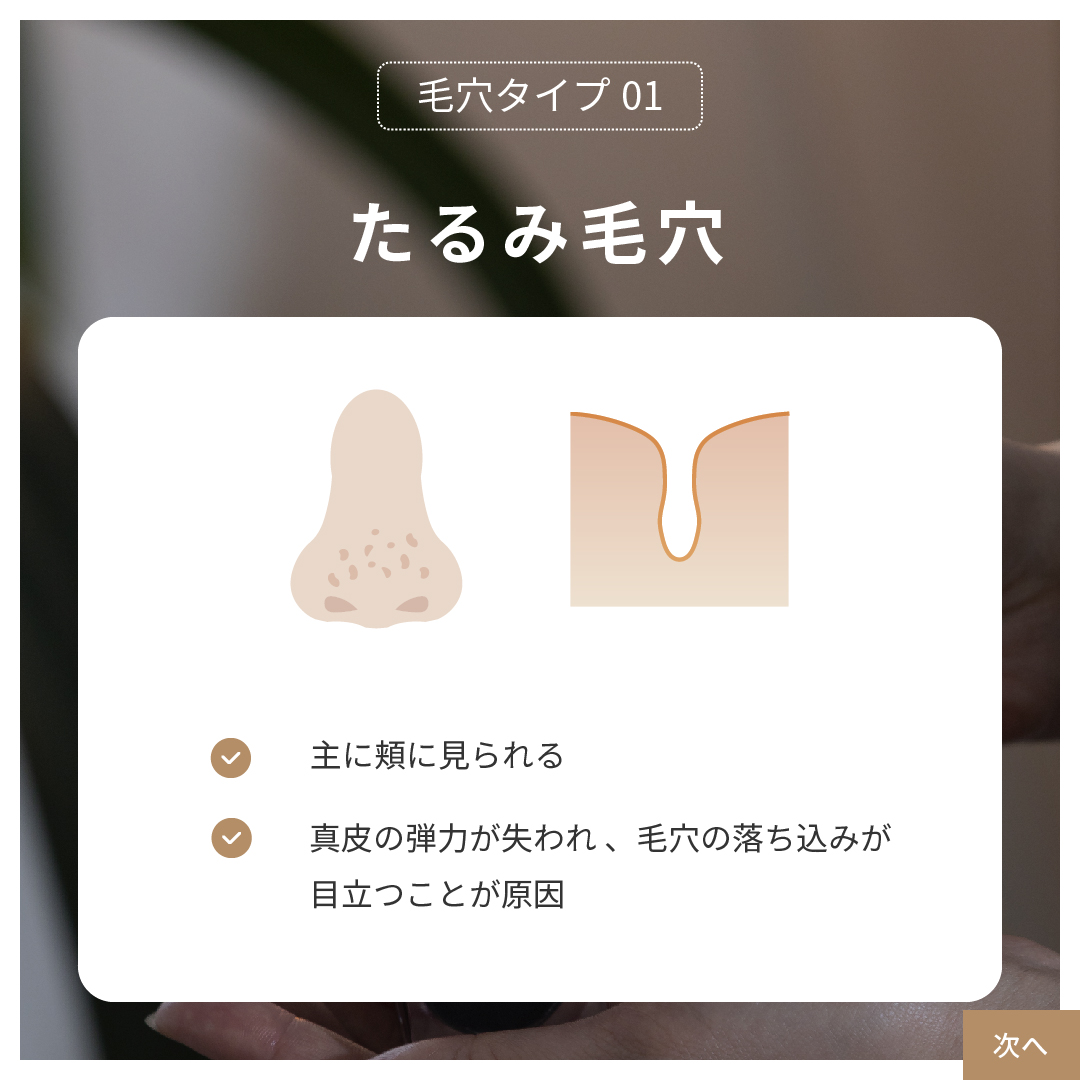【毛穴タイプ１】加齢によるたるみ毛穴