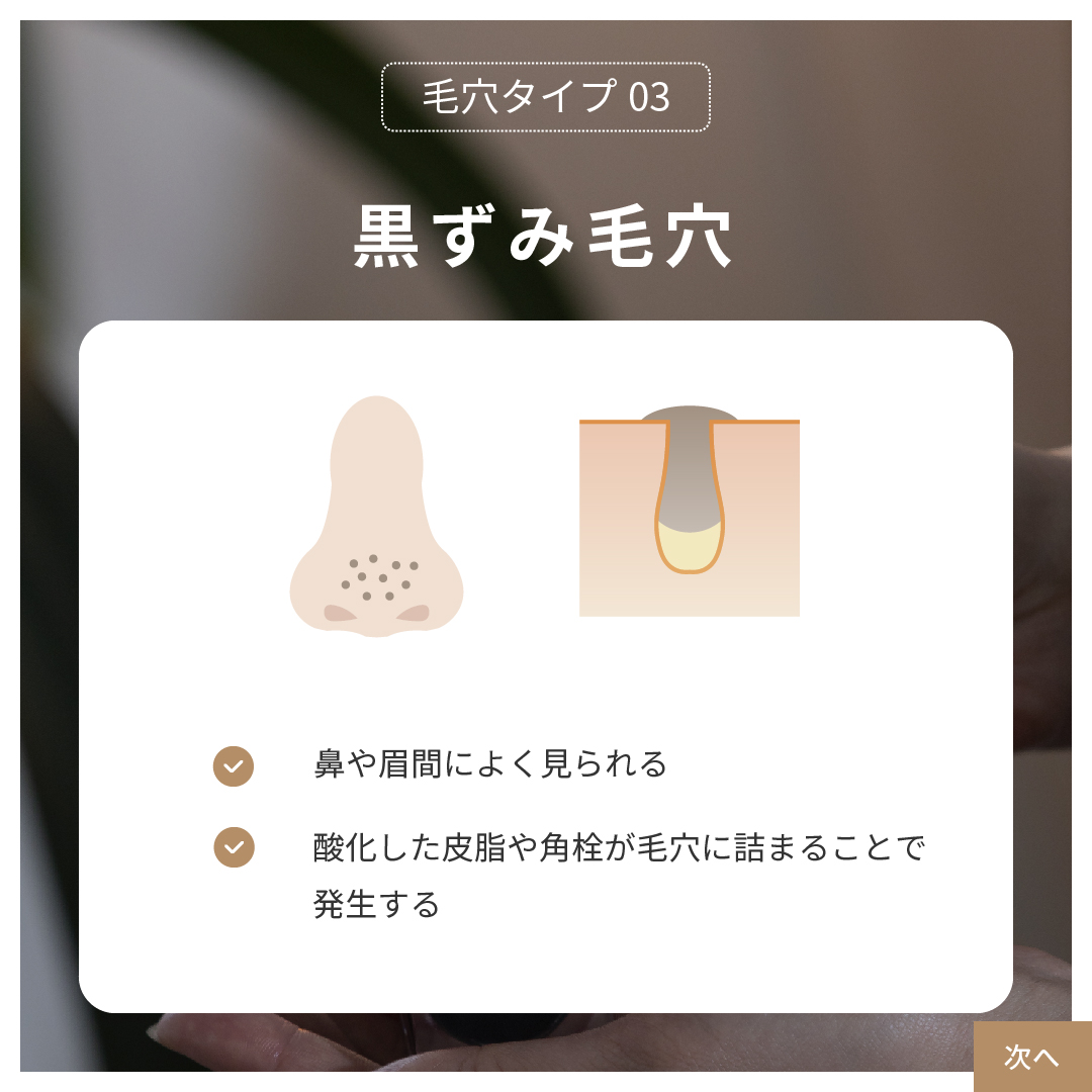 【毛穴タイプ3】過剰なメラニンによる黒ずみ毛穴
