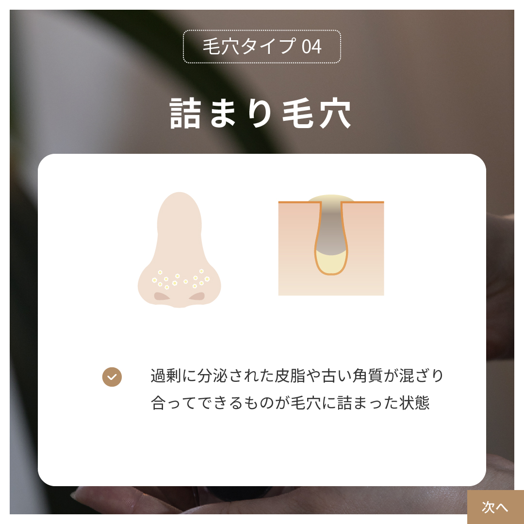 【毛穴タイプ4】肌の代謝が落ちて古い角質が溜まりやすい詰まり毛穴（角栓毛穴）